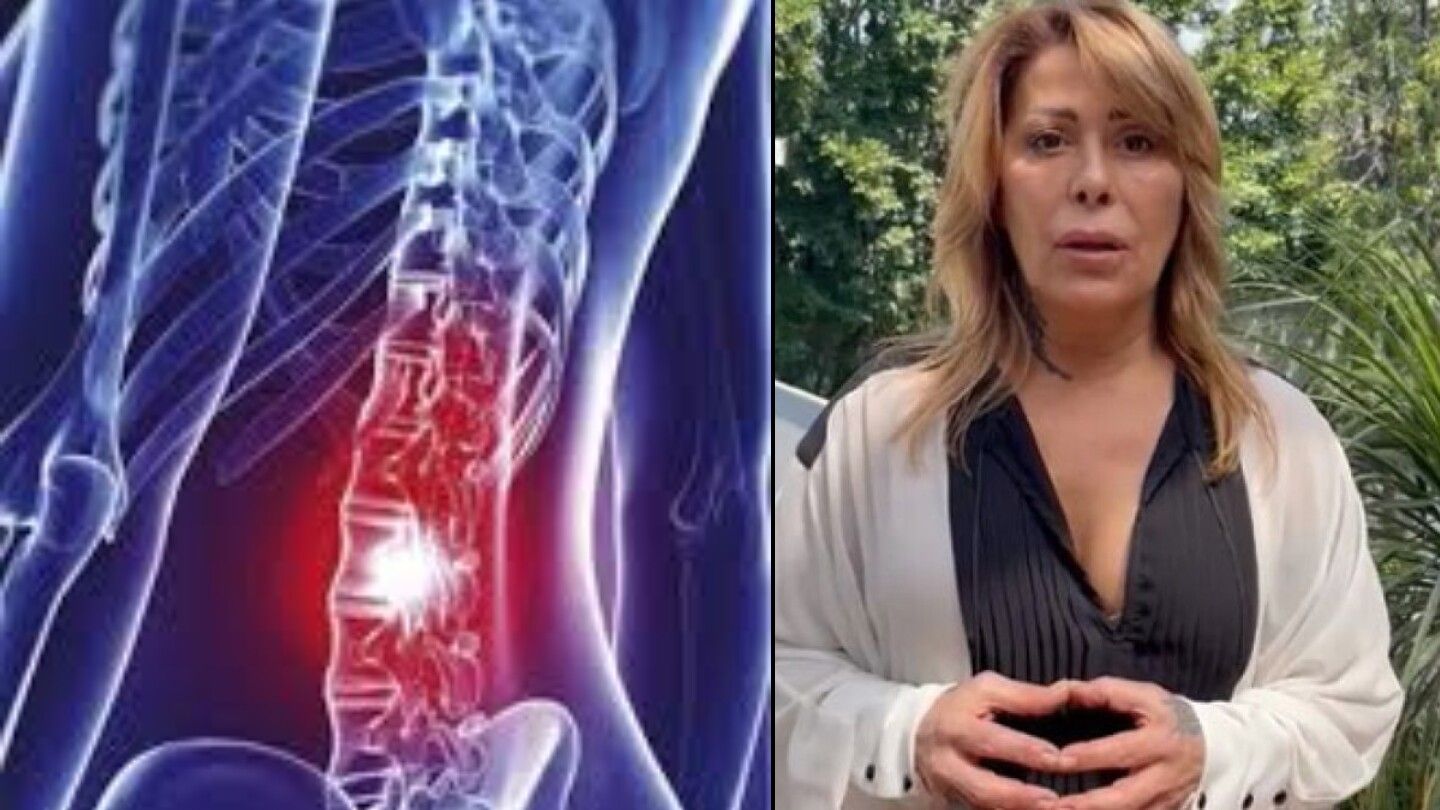 ¿Qué es el síndrome compresivo radicular que tiene Alejandra Guzmán?