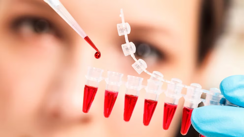 Un test de sangre para detectar más de 50 tipos de cáncer mostró resultados alentadores en un estudio de Oxford