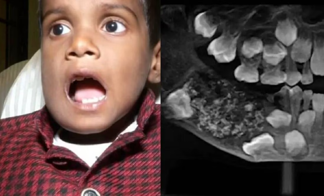 Niño con inusual condición es sometido a cirugía: le extraen 526 dientes
