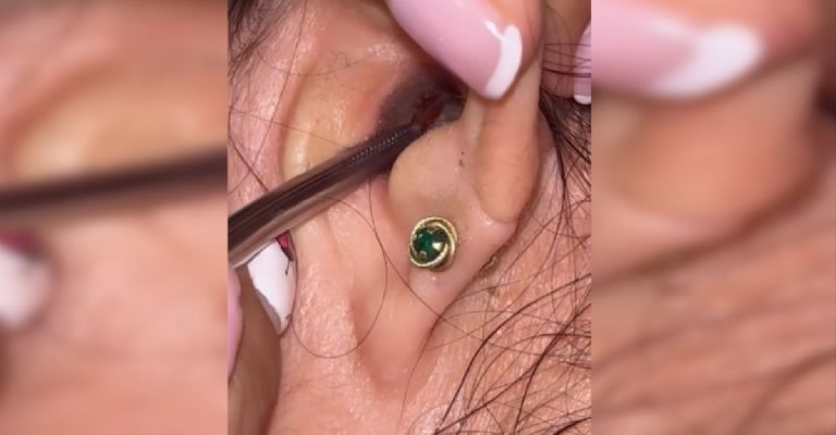 De pesadilla: revisó su oído tras intenso dolor y encontró una cucaracha «viviendo» dentro | VIDEO