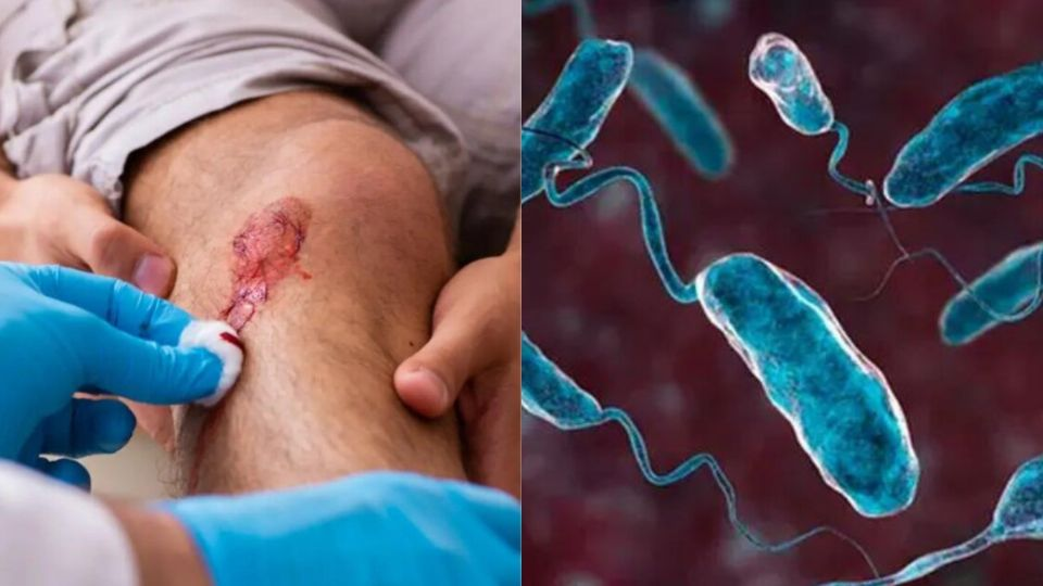 ¿Qué es la bacteria ‘come carne’? Descubre cómo puedes contagiarte con el virus que viene cobrando 23 vidas