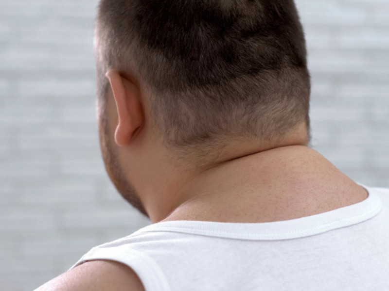 Joroba de Dowager o Búfalo: la deformación en el cuello que no es por mala postura
