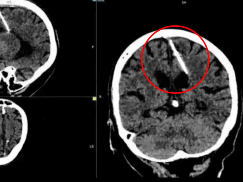 Abuelita descubre que llevó una aguja en el cerebro por 80 años