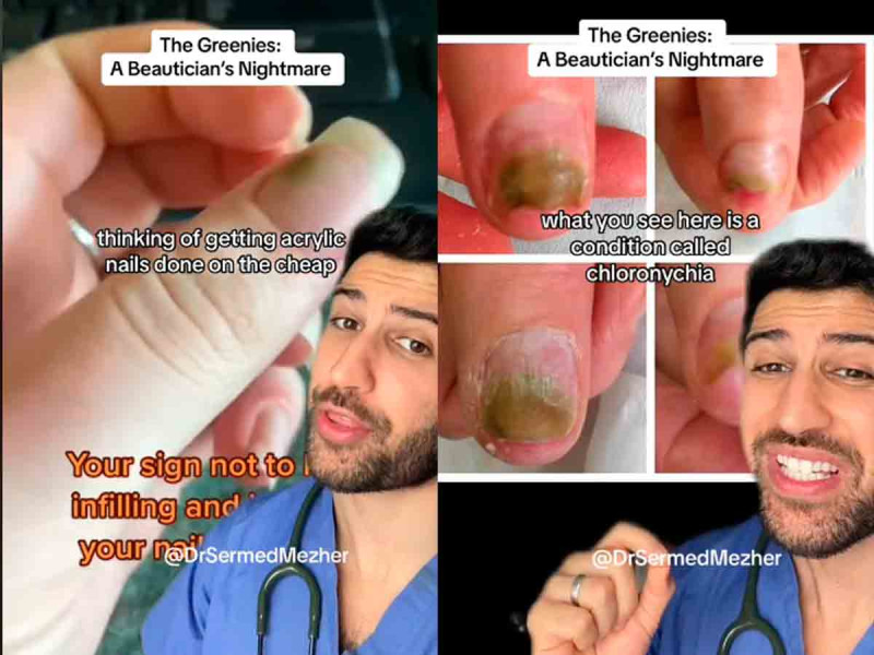 Uñas acrílicas pueden causar una infección ‘de pesadilla’ que las vuelve verdes