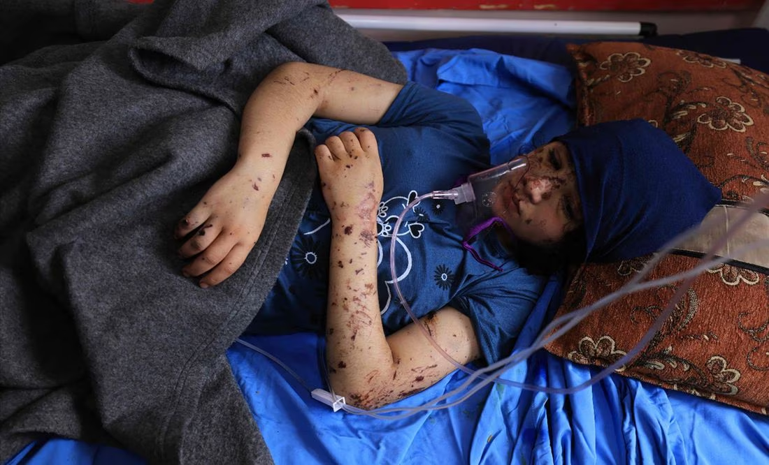«¡Devuélvanme mis piernas!», el grito de niños amputados en la guerra Israel-Hamas en Gaza