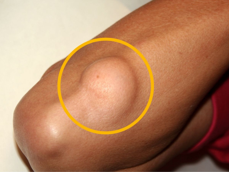 Qué causa el cáncer de grasa, ¿por qué se confunde con lipomas?