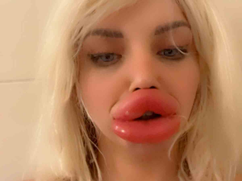 Influencer con enormes labios confiesa que ya no puede comer ni beber bien