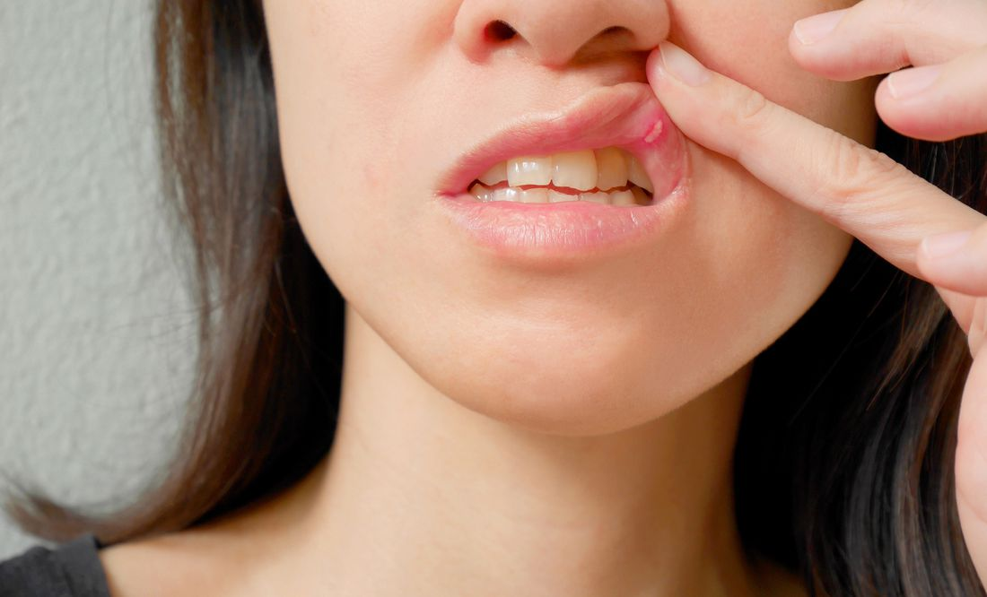 Despídete del dolor: 5 efectivos remedios caseros para eliminar las aftas en la boca