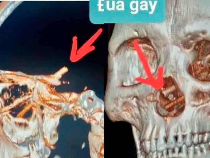 Hombre que sufría dolores de cabeza se entera de que tenía palillos clavados en el cerebro