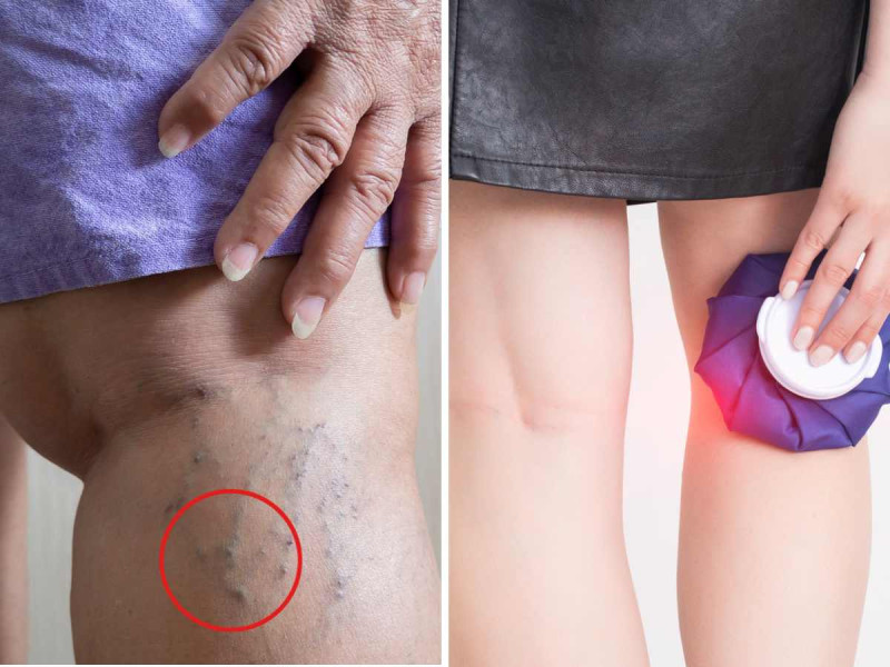 8 tips para desinflamar las venas, antes de que afecten tu salud