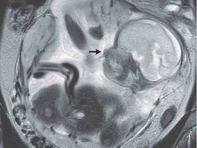Mujer se queja de calambres estomacales y descubre que un bebé se desarrollaba en su intestino