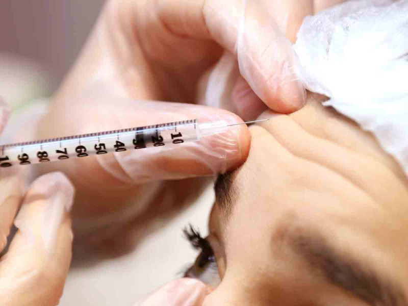 Alertan que uso de bótox podría provocar enfermedad mortal que paraliza los músculos