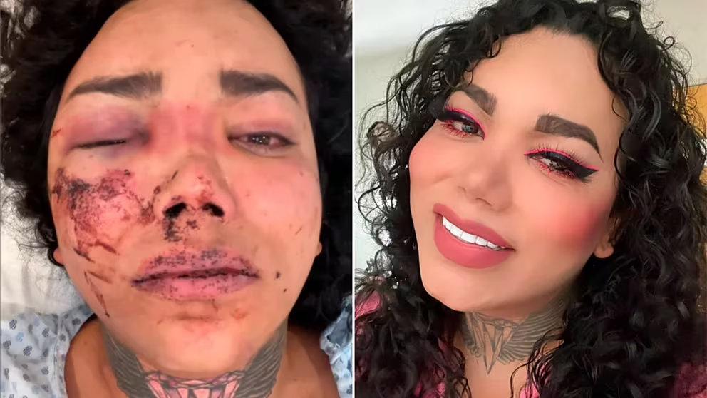 ¿Paola Suárez podría perder la vista tras agresión de su novio? Esto dijo un doctor sobre sus lesiones