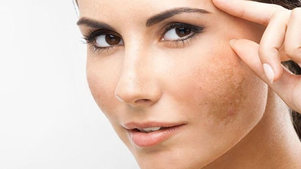 ¿Cómo prevenir el paño en el embarazo? Consejos para que no aparezca en tu rostro