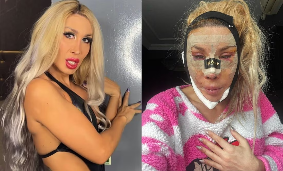 La cantante Pelopony, arrepentida de someterse a 6 cirugías simultáneamente: «Estuve dos días ciega»
