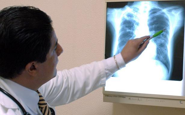 Llama IMSS a identificar signos de tuberculosis