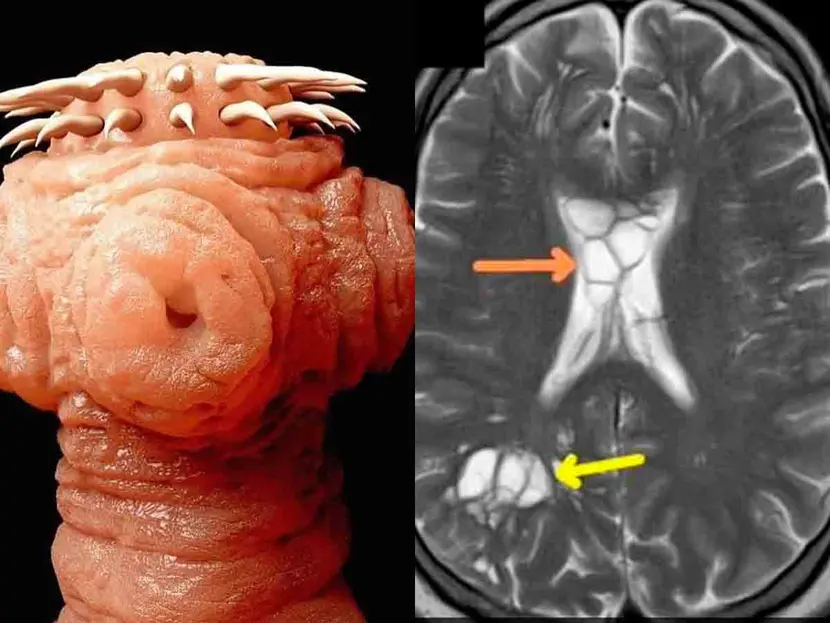 Hombre descubre que su migrañas eran ocasionadas por un gusano vivo en su cerebro