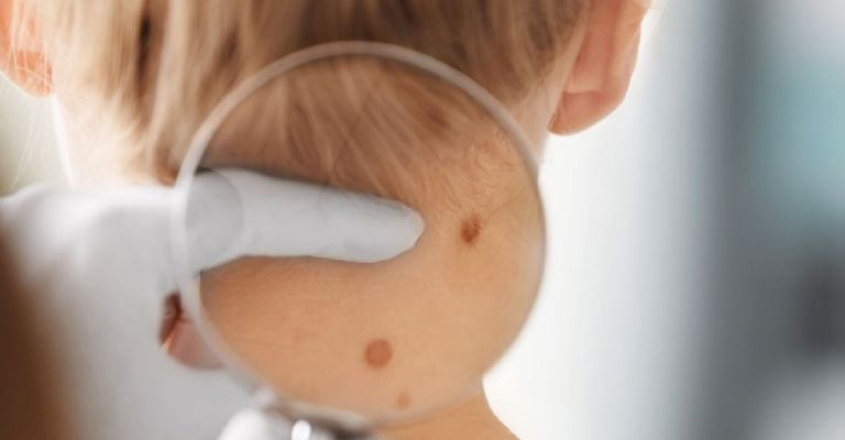 Cáncer de piel: ¿Por qué un hábito cotidiano nos puede salvar la vida?