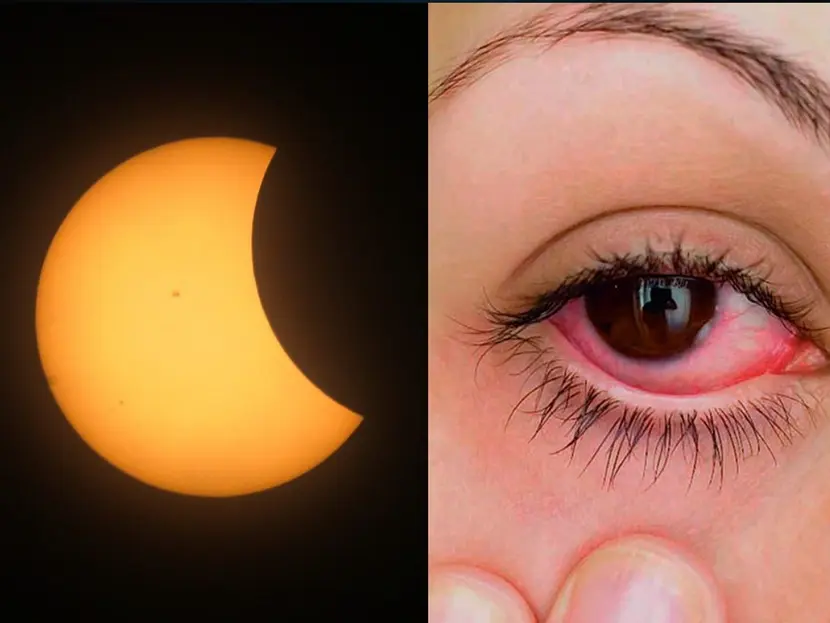 ¿Por qué me duelen los ojos?: búsqueda en Google aumenta después del eclipse solar