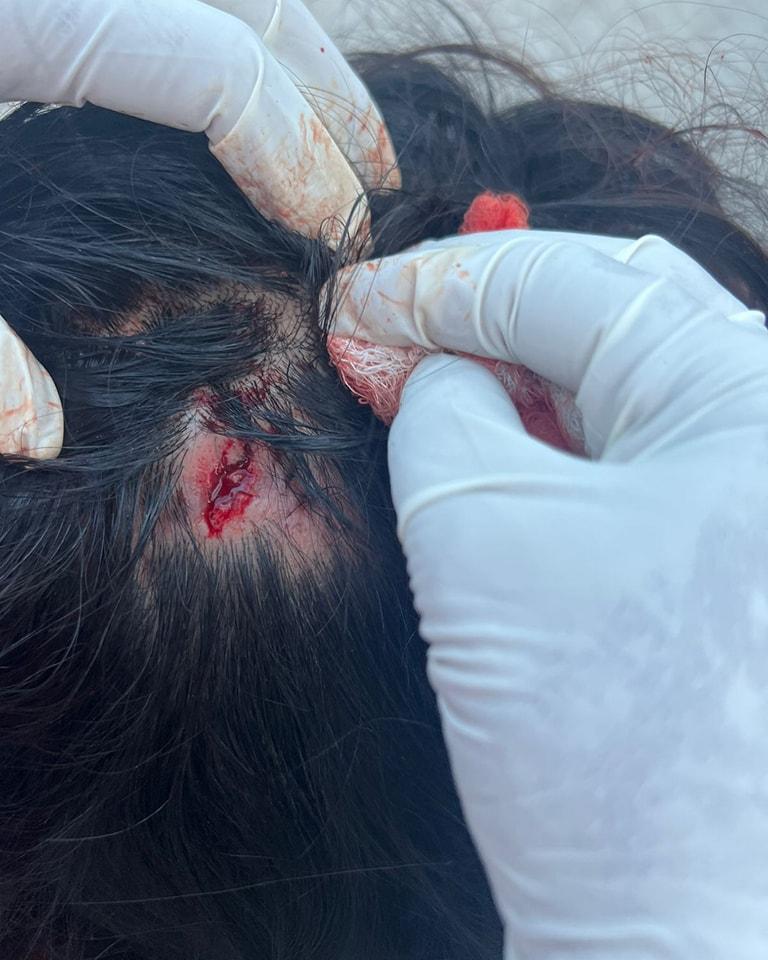 Le abre la cabeza a su pareja, de una pedrada