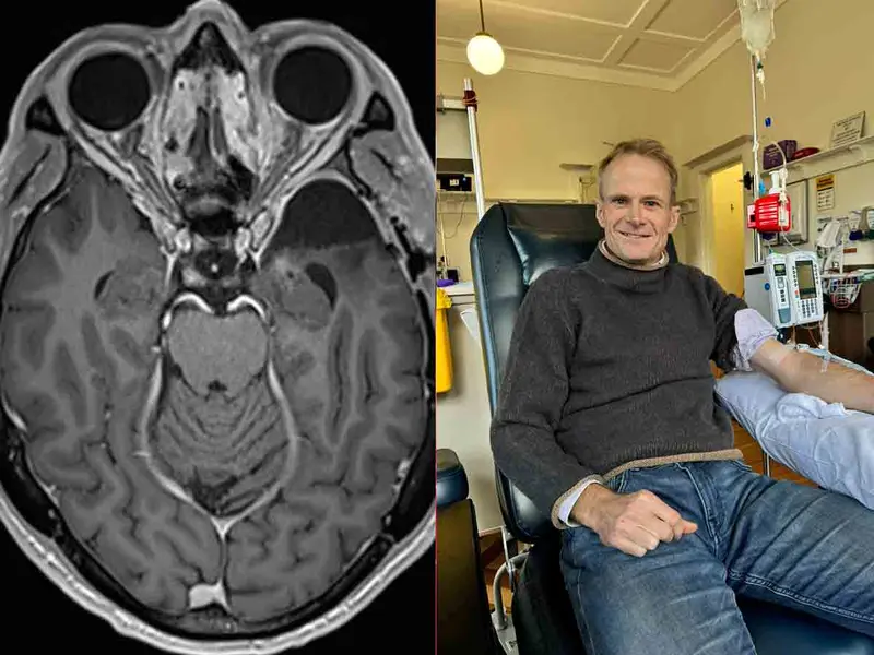 Médico se cura de cáncer cerebral terminal tras someterse a su propio tratamiento revolucionario