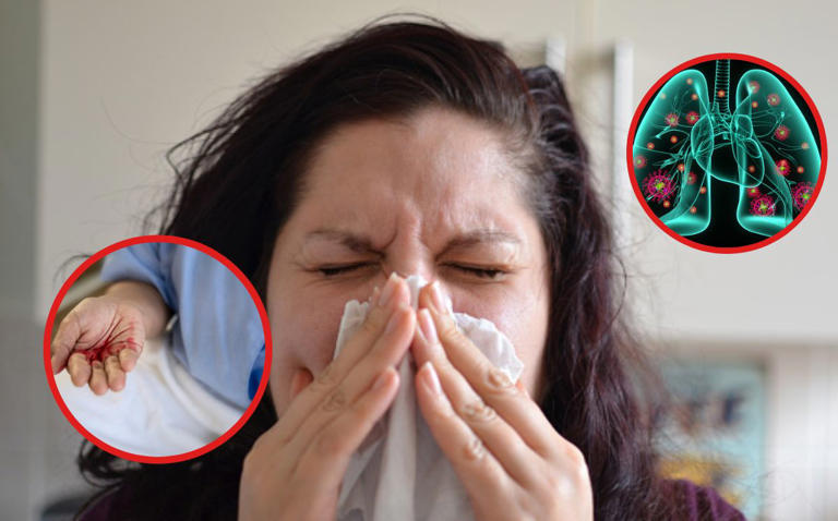 ¿Qué es la poliangeitis microscópica? La escalofriante enfermedad que ataca riñones, piel y pulmones