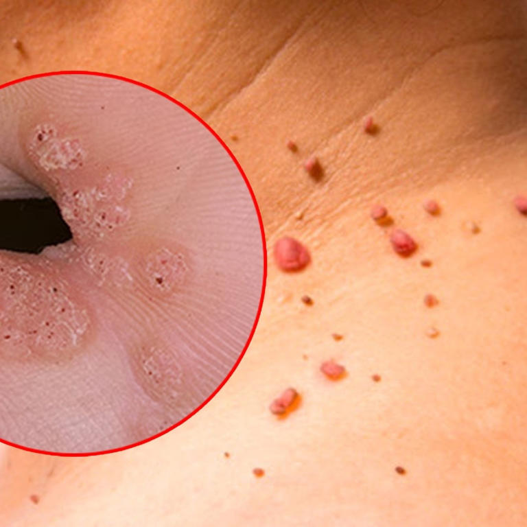 VPH: Cómo detectar el Virus del Papiloma Humano en Mujeres y Hombres