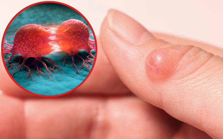 Diferencia entre quistes, nódulos y tumores, ¿cuándo es peligrosa una ‘bolita’ en el cuerpo?