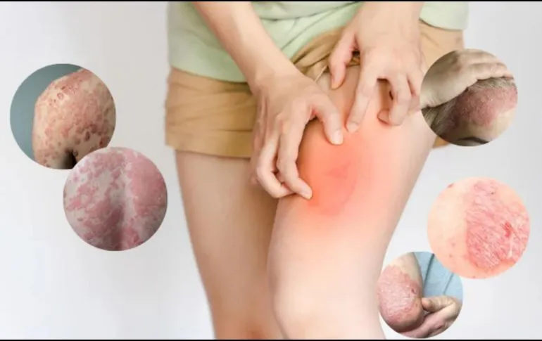 Día Mundial de la Psoriasis: cómo impacta esta enfermedad subestimada