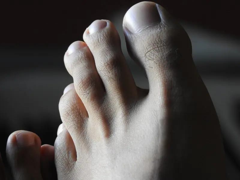 ¿Qué son las uñas enterradas? Causas, síntomas y consecuencias de no tratar