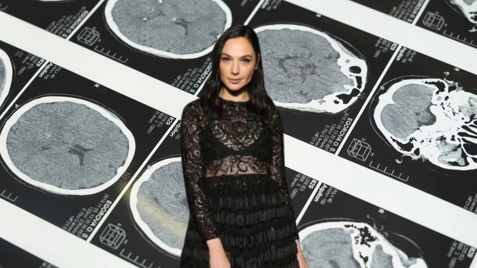 Gal Gadot tuvo una cirugía de emergencia en su embarazo por un coágulo en el cerebro: ¿Qué le pasó?