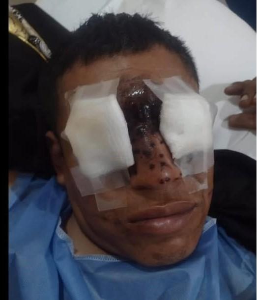 Tras explosión de cohetes logran salvarle los ojos