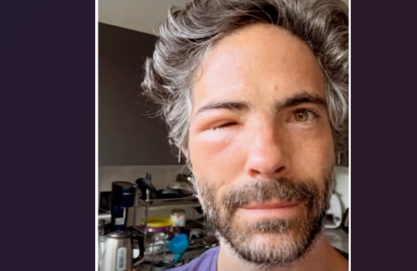 Osvaldo Benavides aparece con el rostro desfigurado y alarma a sus fans