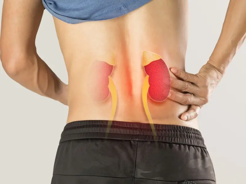 ¿Cómo saber si ese dolor abdominal es un cólico renal (cólico nefrítico) o un retortijón?