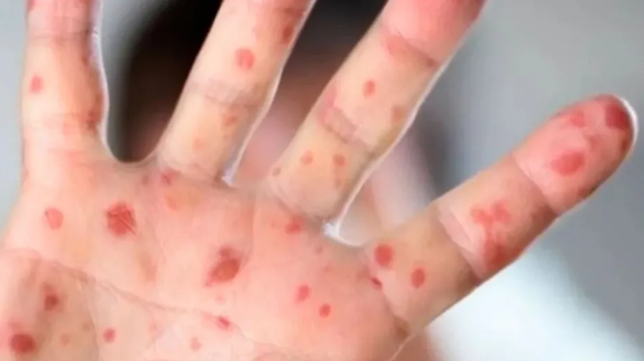 Aumenta a 25 los casos de niños menonitas contagiados de sarampión en Chihuahua