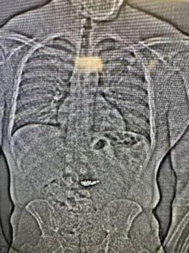 Ladrón se traga aretes de diamantes valorados en 770 mil dólares para evitar su arresto en Florida