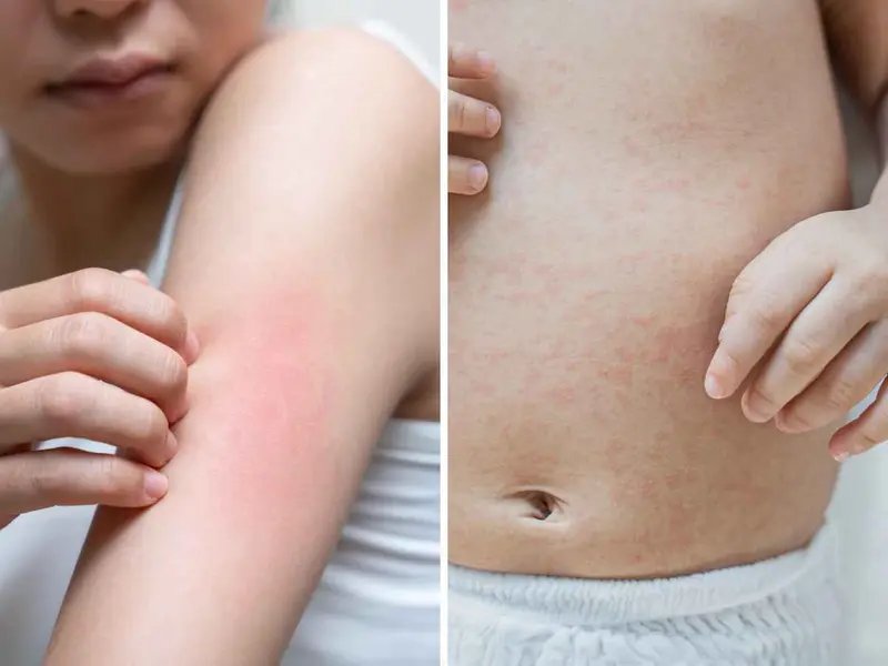 Sarpullido por calor en bebés: por qué es frecuente y cómo cuidar su piel para aliviarlo