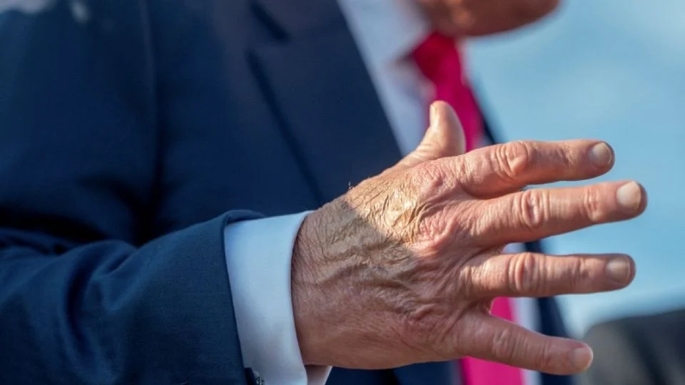 En qué consiste la insuficiencia venosa crónica que afecta a Trump
