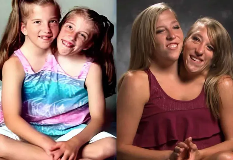 La inspiradora vida de Abby y Brittany Hensel, siamesas que comparte cuerpo ¿y ahora también un bebé?