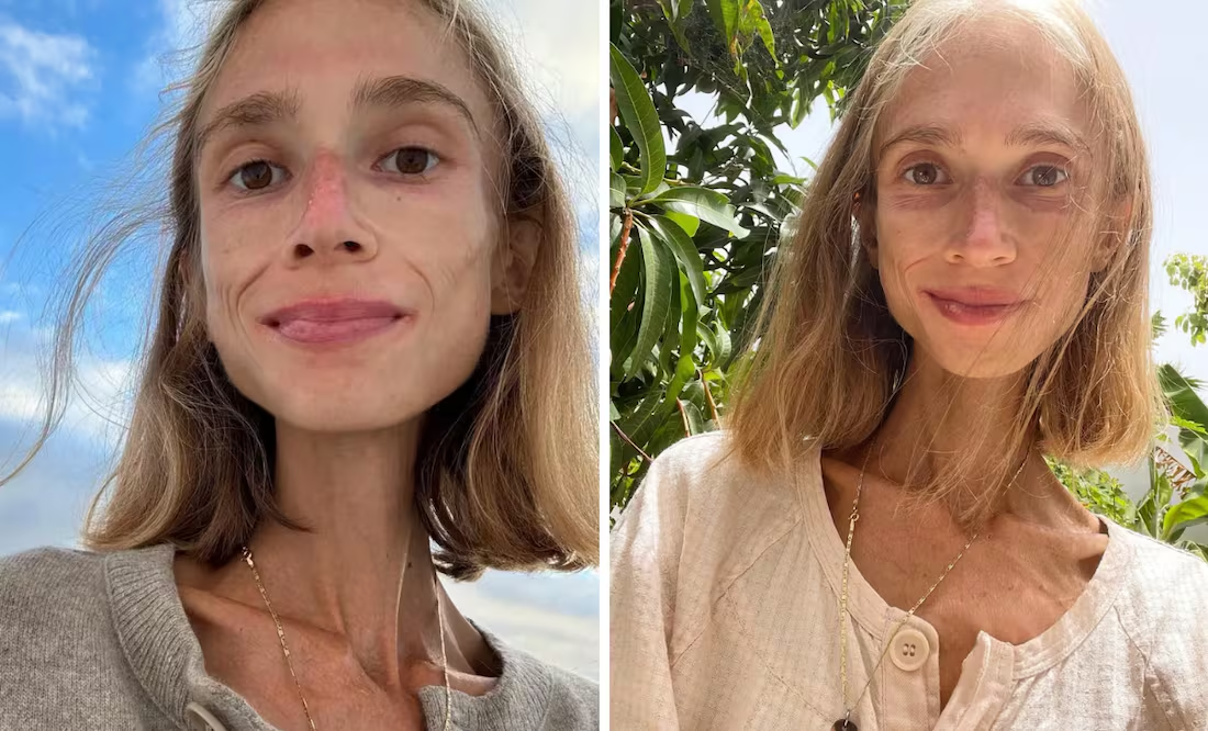 ¿Quién era Karolina Krzyzak, la joven vegana de 27 años que perdió la vida tras pesar 22 kilos?