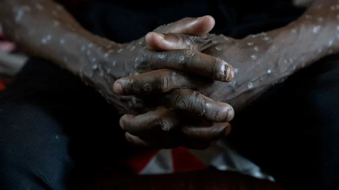 Congo declara fin de brote de mpox, tras dos años y más de 2 mil 200 muert3s