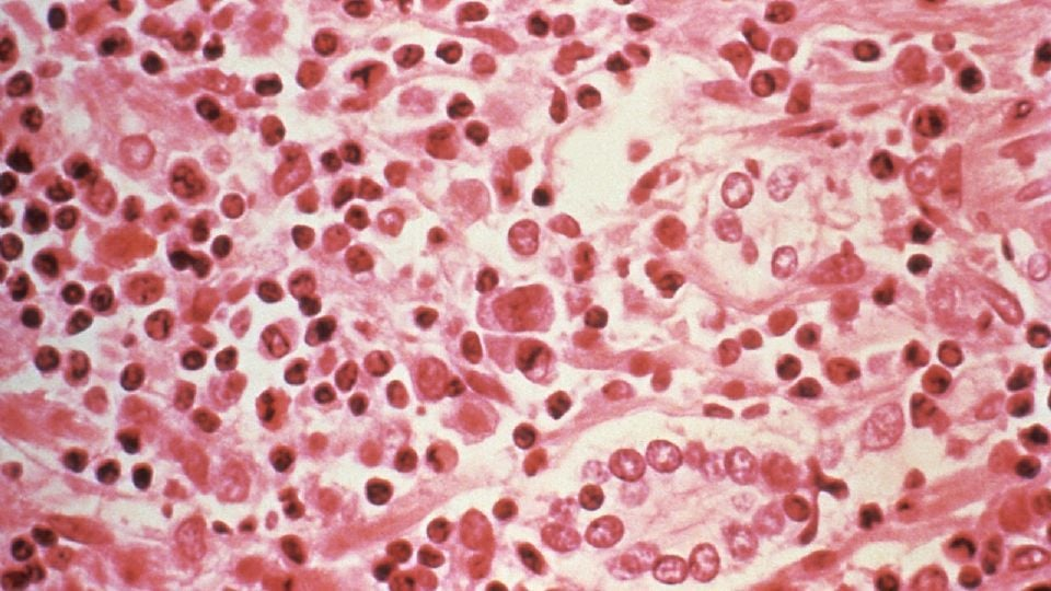 Evacuarán del crucero a tres pacientes con hantavirus en Países Bajos; reportan que su estado de salud es grave