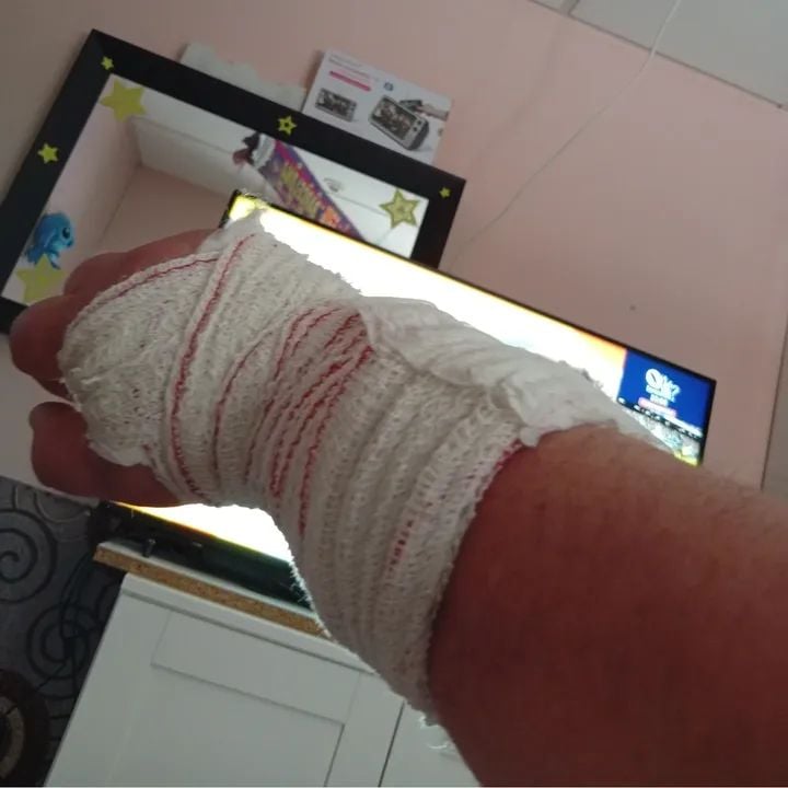 ¡Ataca perro a un hombre y casi le arranca la mano!